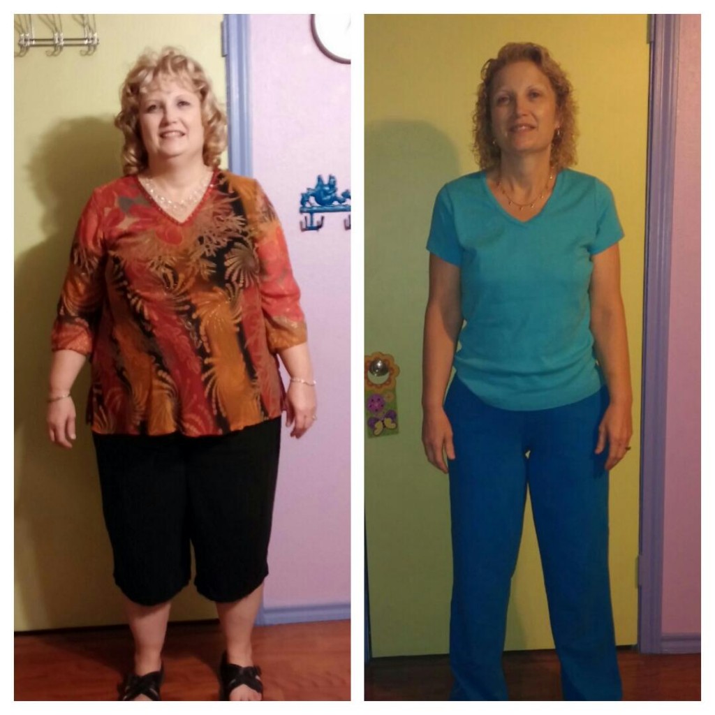 Patient before and after weight loss surgery transformation