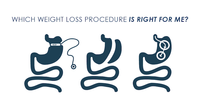 which weight loss procedure is right for me graphic