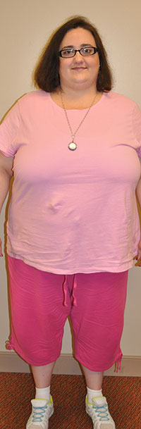 Patient before weight loss surgery