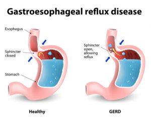 gastroeseophageal reflux disease graphic 